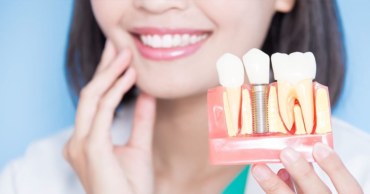 Implante dente em Itapema Implante dente em Itapema